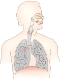 LuCID – un nou dispozitiv de detecţie a cancerului de plămâni