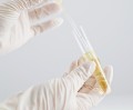 Un test de urină pentru diagnosticarea cancerului pancreatic incipient
