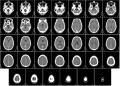 Un nou sistem de clasificare a tumorilor cerebrale