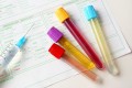 Un test de sânge și urină pentru detectarea cancerului renal