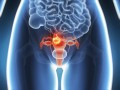 Mutația genei BRCA1 poate crește riscul pentru cancerul uterin