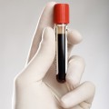 Un test de sânge ar putea decide tratamentul cancerului colorectal