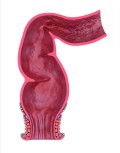 Dezvoltarea sau recidiva cancerului colorectal ar putea fi oprită cu ajutorul unui plasture special