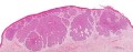 Cum migrează celulele canceroase în organism?