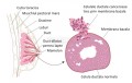 Reducere a deceselor cauzate de cancerul de sân la nivel global