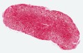 Testul care face diferența între celulele agresive și cele inofensive în cancerul de prostată