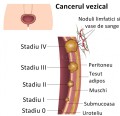Cancerele avansate ale vezicii urinare răspund la imunoterapie indiferent de statusul mutațiilor gen