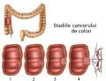 Un nou tratament ar putea extinde supraviețuirea la pacienții cu cancer colorectal avansat