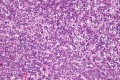 O nouă strategie de tratament și-a dovedit eficiența împotriva unei forme comune de cancer hepatic la copii